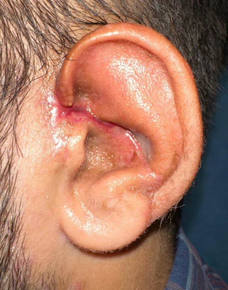 पिटबुल ने 22 वर्षीय युवक का कान काटा, अमृता अस्पताल ने पुनर्निर्माण सर्जरी कर किया सफल इलाज